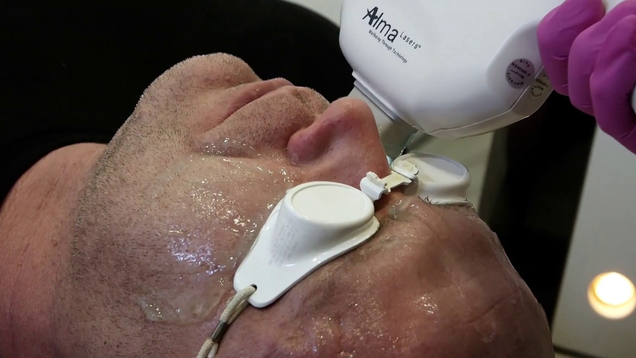Likwidacja rumieńia laserem Alma Harmony  XL Pro DyeVL