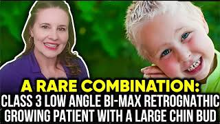Class 3 Bimax Retrusive Low Angle Case- Growing Child