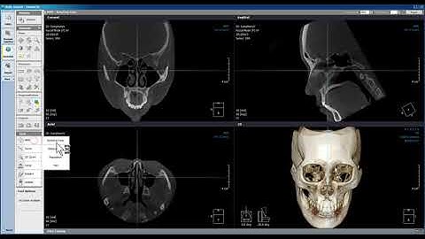 Xelis Dental Case Tutorial Reposition
