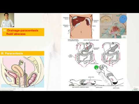 Peritonitis. Viêm phúc mạc. Part 1. Anatomy of peritoneum