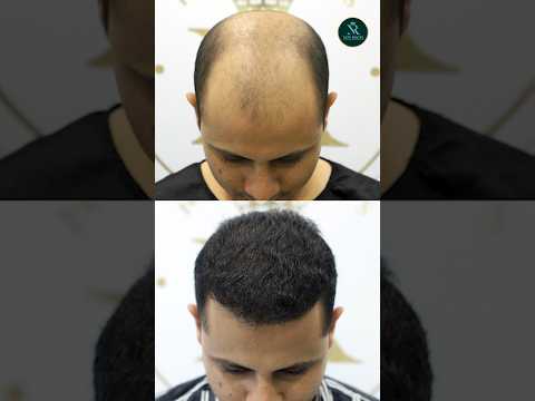 UNBELIEVABLE Hair Results! Best Transplant in Bangalore #besthairtransplant #bangalore #shorts