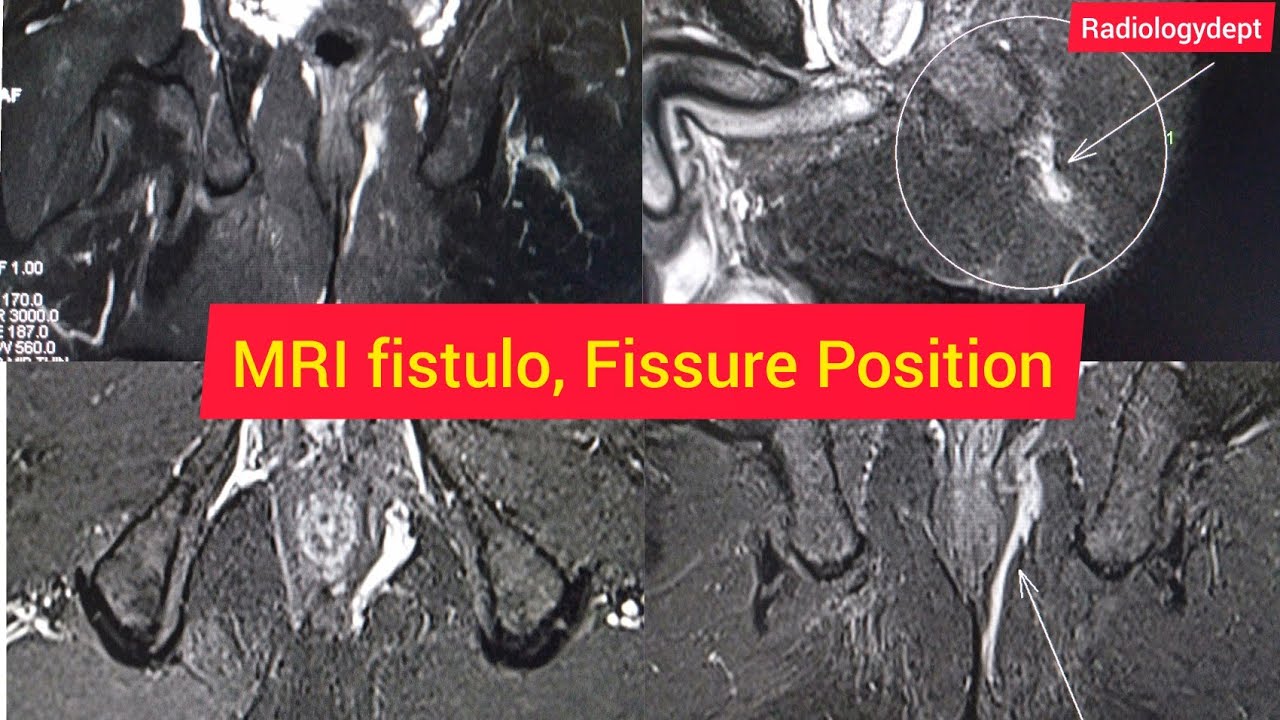 Mri fistulagram Check Possition in Hindi | #Fistulagram @Radiology Dept   How to check #mriFissure
