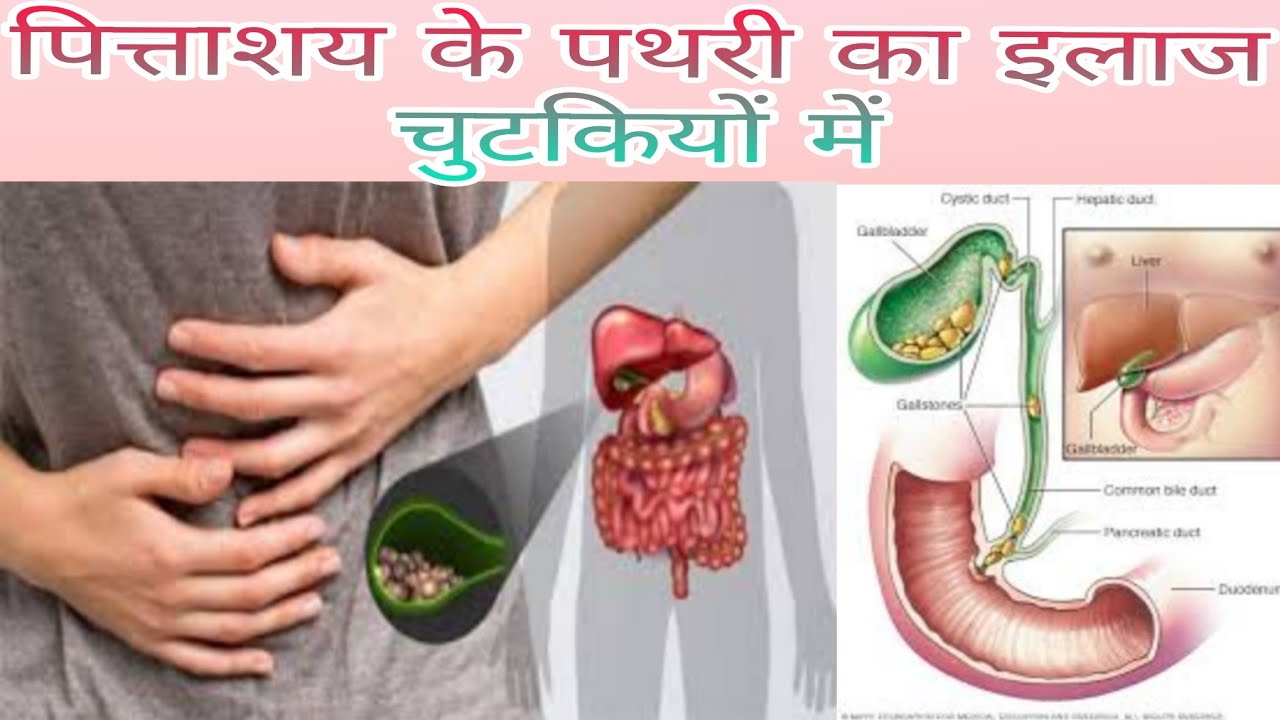 🪨Pittashay Ki Pathri Ka Ilaaj/Pathri Hone Ke Karan/Pathri Ke Lakshan