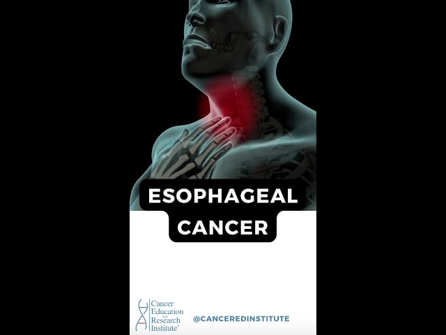 What is Esophageal Cancer? | Cancer Education and Research Institute (CERI) #canceredinstitute class=