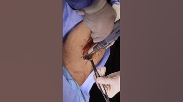 Broken Bone Fixed in 3 Minutes? China’s Miracle Tech!| #shorts |#viral |#youtubeshorts | #facts