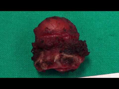 thyroglossal duct&rsquo;s cyst excision - Sistrunk&rsquo;s procedure