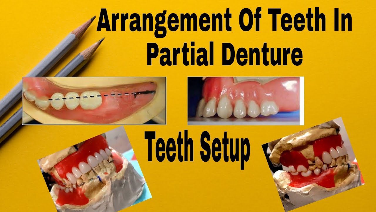 Teeth Setting Arrangement of Teeth in Partial Denture || Teeth Seeting in Partial ...