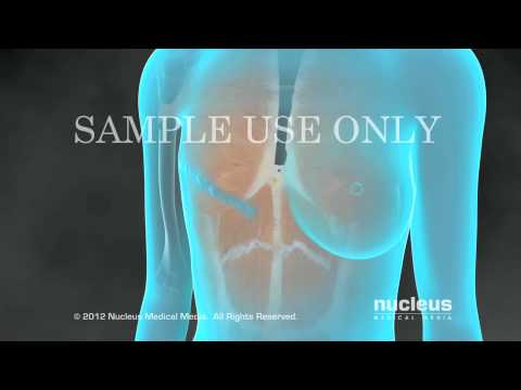 Video: ¿La reconstrucción mamaria incluye un pezón?