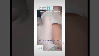 تركيب شريحة منع الحمل