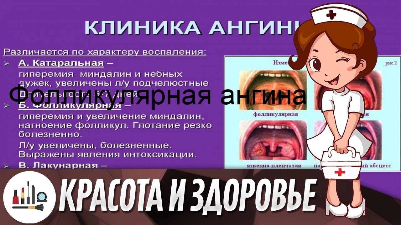 Фолликулярная ангина - YouTube