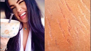 HOW TO GET RID OF STRETCH MARKS (Naturally + Fast) | DIY Stretch Mark Removal Serum 100% Works