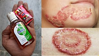 80 साल पुराने दाद खाज खुजली की 60 सेकंड में छुट्टी कर देगा,fungal,daad khujli treatment solution