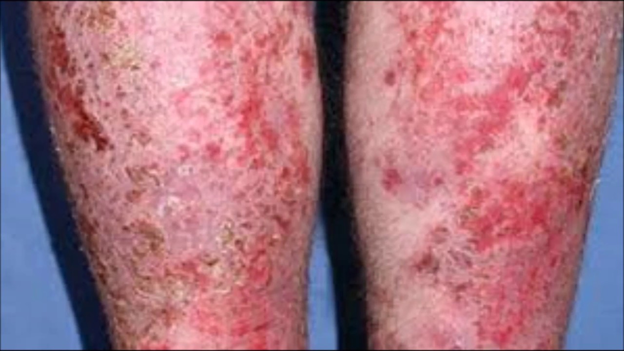 Eczema Treatment: Eczema skin disease 