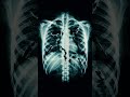 AI Catches Deepfake X-Rays Better Than Doctors