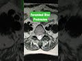 Foraminal Disc Protrusion #viral #youtubeshorts #shorts