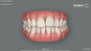 Simulación 3D De Caso De Ortodoncia Invisible Invisalign Invisalign Tenerife