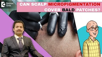 INSTANT HAIR LOSS SOLUTION|Scalp Micropigmentation for Hair Loss-Dr.Deepak P Devakar|Doctors