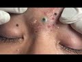 ystic Acne Extraction This Week, Blackheads Removal, Blackhead Extraction #