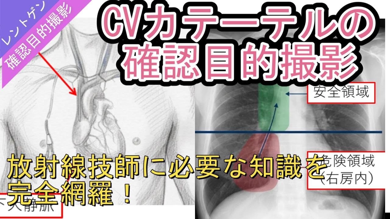CVカテーテルの確認目的撮影
