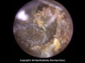 207: Impacted EAR WAX PLUG removed with help of Olive Oil - Mr Neel Raithatha (THC)