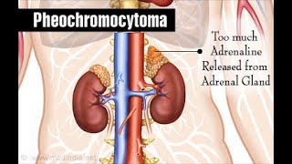 Pheochromocytoma: Symptoms, Pathophysiology, Diagnosis and Treatment