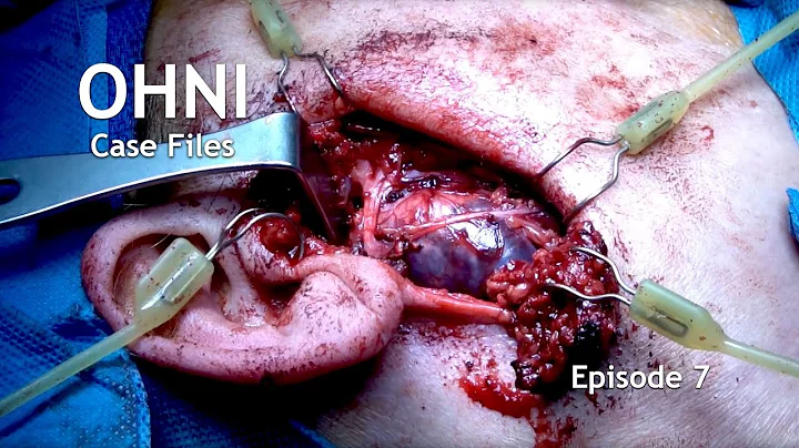 WOMAN with DEEP LOBE PARAPHARYNGEAL SPACE TUMOR