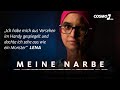 Lena wurde vom Blitz getroffen – die Verbrennungen haben Narben hinterlassen | Meine Narbe | COSMO