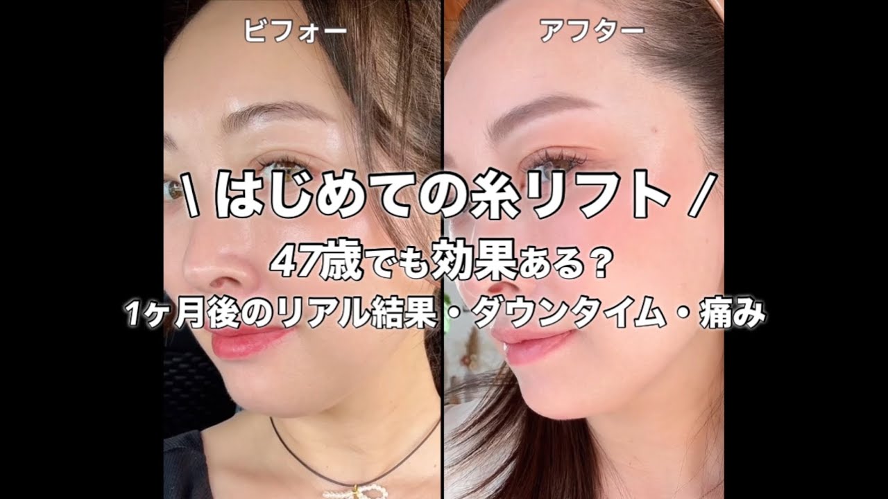 \はじめての糸リフト/47歳でも効果ある!?1ヶ月後のリアル結果・ダウンタイム・痛み