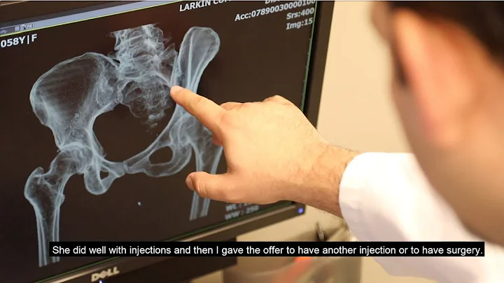 Sacroiliac Joint Fusion with the iFuse Implant Sys...