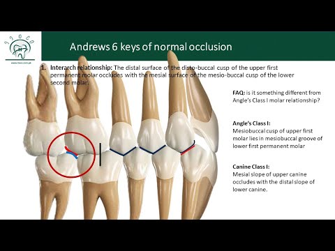 Andrew's 6 Keys of Normal Occlusion (Lesson 1 (1st key) )