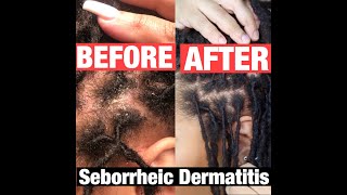 How I manage Seborrheic Dermatitis With Locs!