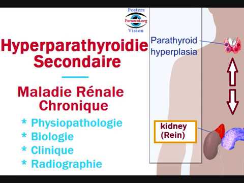 Hyperparathyroidie Secondaire et maladie Renale Chronique