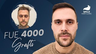 Stunning 12-Month Transformation 4000 Grafts Hair Transplant | Before & After Results!