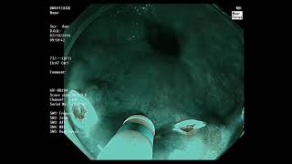 Tandem Talk: "Endoscopic management of SCC and EGC" by Prof Philip Chiu and Dr Noriya Uedo