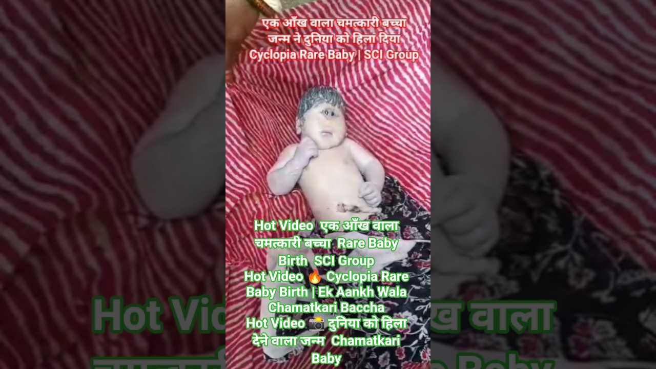 दुनिया को हिला देने वाला जन्म एक आँख वाला बच्चा Rare Medical Case#RareCase#shorts #ChamatkariBaccha