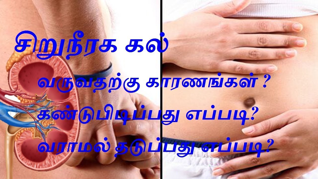 how to remove kidney stone in one day in Tamil kidney