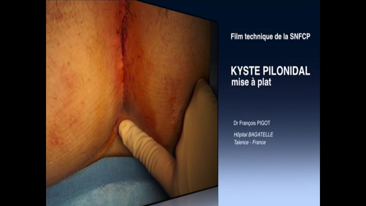 Kyste Pilonidal Qui Eclate Que Faire