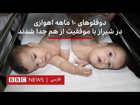 دوقلوهای ۱۰ ماهه اهوازی در شیراز با موفقیت از هم جدا شدند