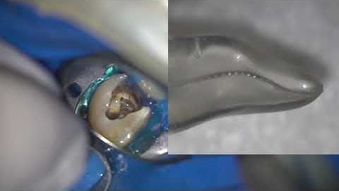 S-shaped canals glide path and instrumentation with tactile controlled activation technique