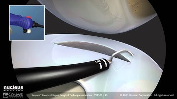 ConMed: Linvatec™ Sequent Meniscal Repair
