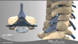 Posterior Cervical Laminectomy & Fusion at Swift Institute, Reno, Sparks, Carson City