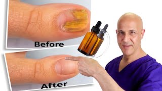 1 Oil Cures Toe Nail Fungus | Dr. Mandell by motivationaldoc 165,033 views 3 weeks ago 4 minutes, 50 seconds