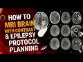 MRI Brain with Contrast & Epilepsy Protocol | Step-by-Step Guide (Siemens 1.5T / 3T)