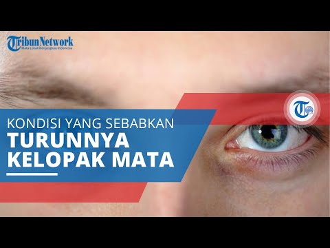 Video: Sindrom Horner: Penyebab, Gejala, Dan Perawatan