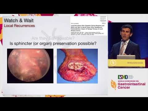 Debate: Complete Response in Rectal Cancer? - Watchful Waiting