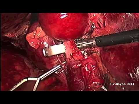 Anatomic Laparoscopic Liver Resection