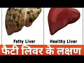 फैटी लिवर के लक्षण 😯 | Symptoms of Fatty Liver 😨