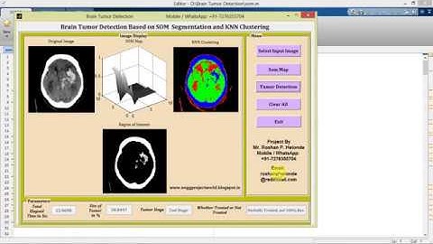 Brain Tumor Detection Using Segmentation and KNN Clustering Matlab Project with Source Code