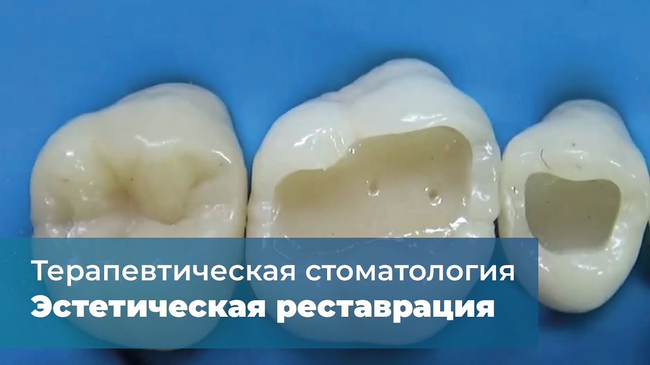 Прямая непрямая реставрация. Реставрационная стоматология. Терапевтическая реставрация стоматология. Реставрация жевательных зубов. Реставрация жевательного зуба.