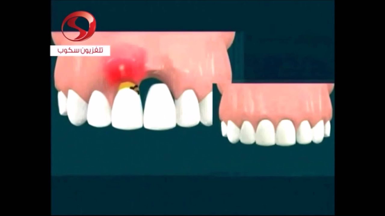 زراعة الأسنان الفورية بعد قلع الأسنان C Youtube